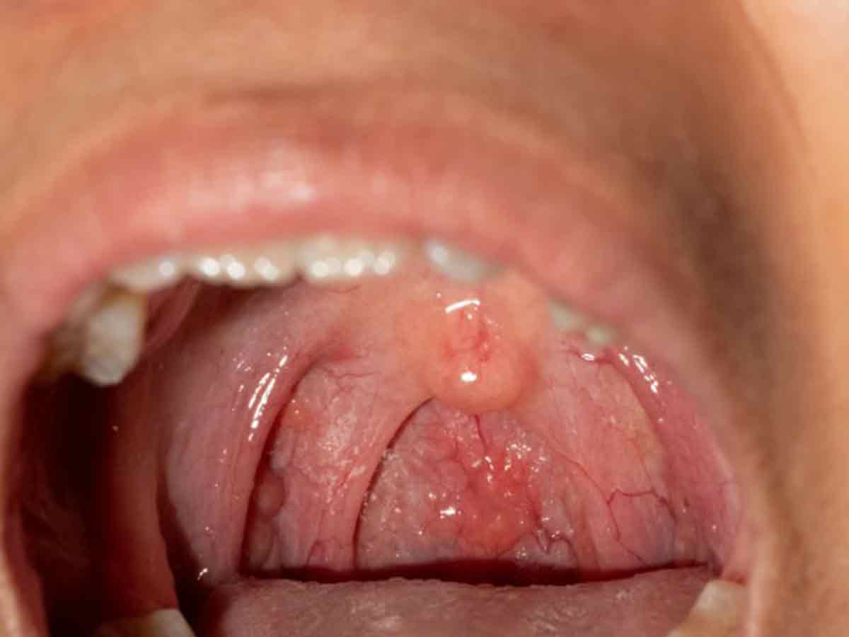 Virus del Papiloma Humano en la boca